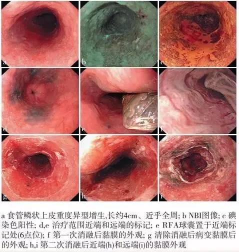 食管癌早期筛查手段,早期食管癌内镜的切除方式有哪些