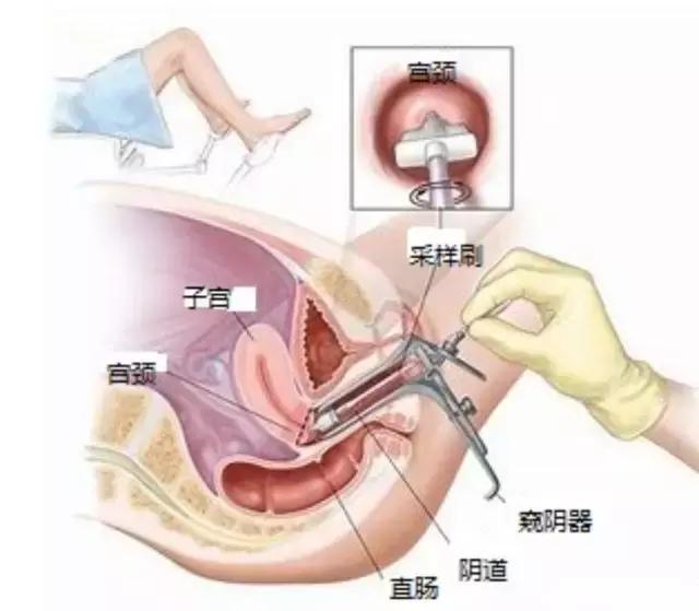宫颈癌发病上升但可防可治,远离宫颈癌侵袭的妙招有哪些