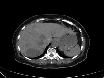 血管肉瘤的治疗方法,头皮恶性血管肉瘤治愈案例
