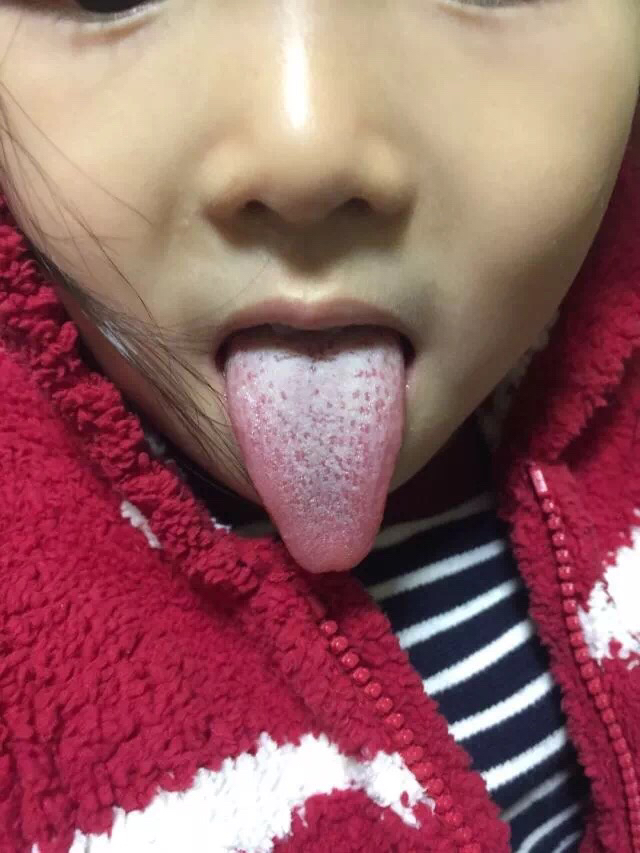 宝宝舌苔厚怎么办小妙招,宝宝舌苔厚怎么办