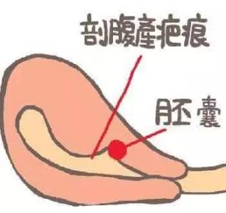 瘢痕子宫关注事项,瘢痕子宫厚2mm关注什么