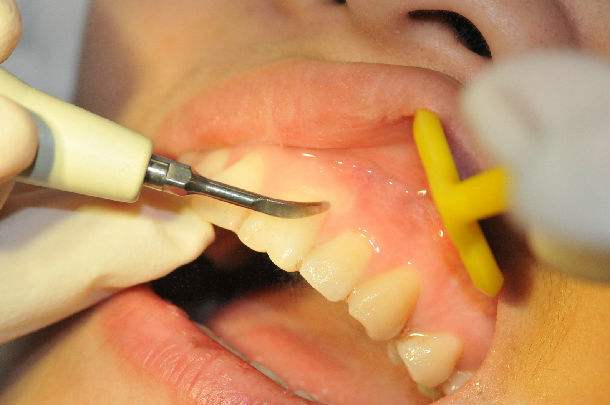 怀孕的时候牙病怎么办,怀孕期有牙病怎么办