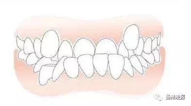 6岁小孩底下长出两排牙,6岁男孩牙齿长了双排