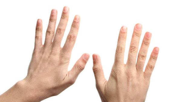 汗疱疹就长在一个手指头上,汗疱疹像针扎一样疼