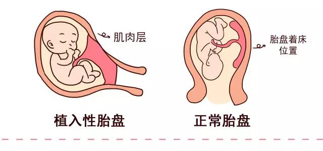 瘢痕子宫关注事项,瘢痕子宫厚2mm关注什么