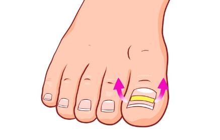 治疗甲沟炎的偏方花椒和啥,孩子得了甲沟炎怎么自己治疗