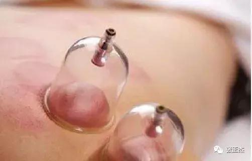 拔罐后皮肤颜色，反应出身体健康的不同问题