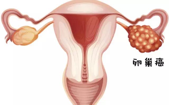 感染hpv必然得宫颈癌吗,感染hpv的女性有几成会得宫颈癌