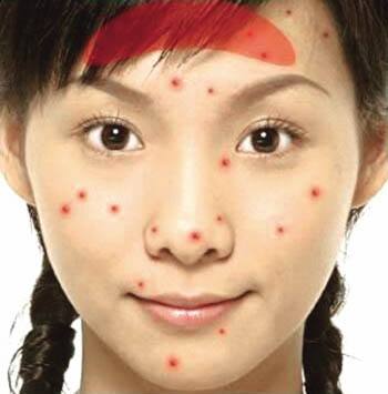 下巴总是反复长痘是哪个器官不好,脸颊反复长痘上医院看了一直不好