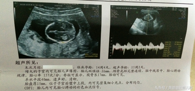 孕期想检查羊水是否正常,孕期看化验单