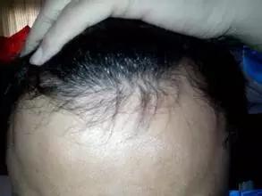 头发顶部稀怎么补救,头顶头发稀怎么治疗