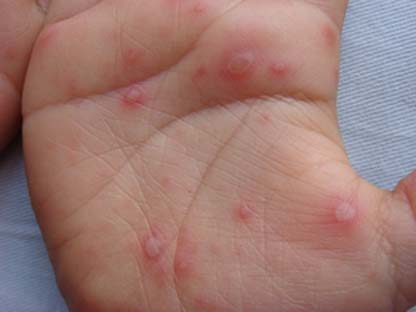 手足口病严重的有没有危险,手足口病第几天最危险