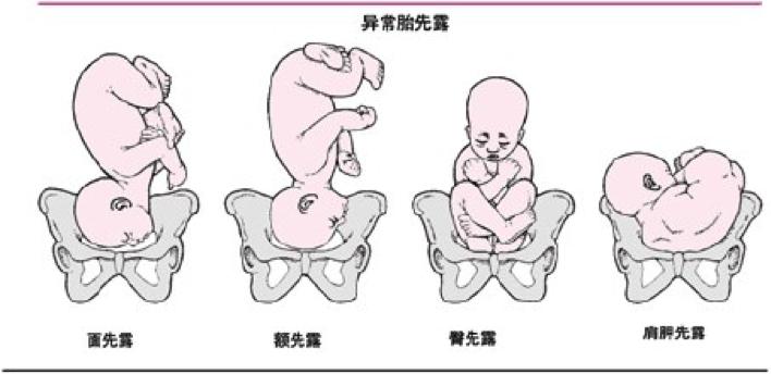 孕妇胎位低的两大原因,孕妇是什么问题导致胎位不正