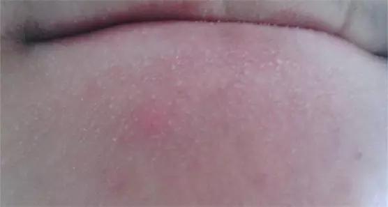 痘痘科普视频,痘痘知识科普祛痘印