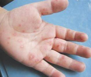 手足口病严重的有没有危险,手足口病第几天最危险