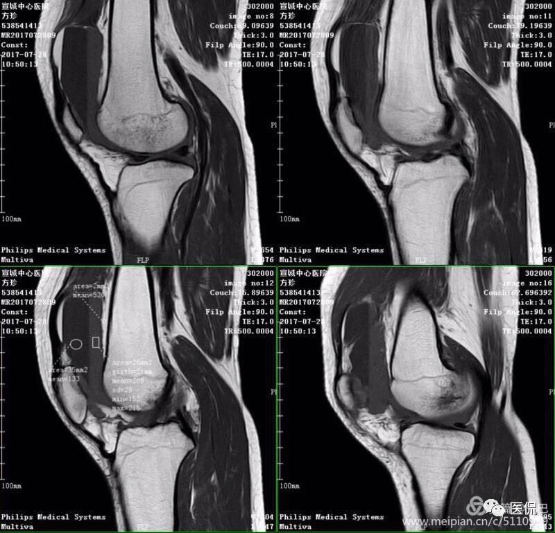 膝关节创伤性积脂血症的临床表现,创伤性积脂血症什么意思