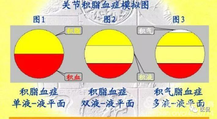 膝关节创伤性积脂血症的临床表现,创伤性积脂血症什么意思