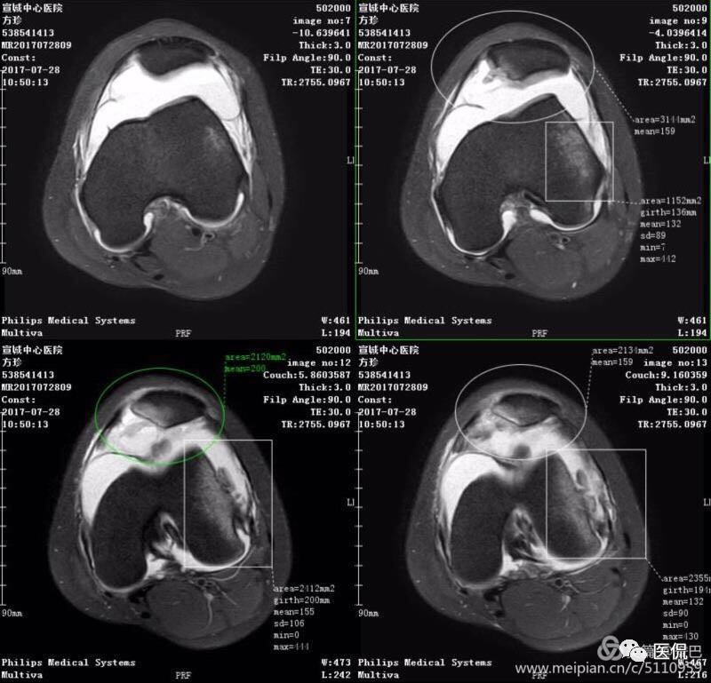 膝关节创伤性积脂血症的临床表现,创伤性积脂血症什么意思