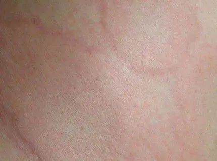 儿童出荨麻疹体温一直37度3怎么办,小儿感冒了出现荨麻疹怎样治疗