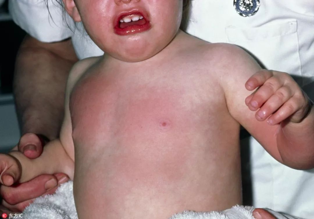 孩子烫伤的紧急处理四大步骤,孩子烫伤后怎么护理好得快