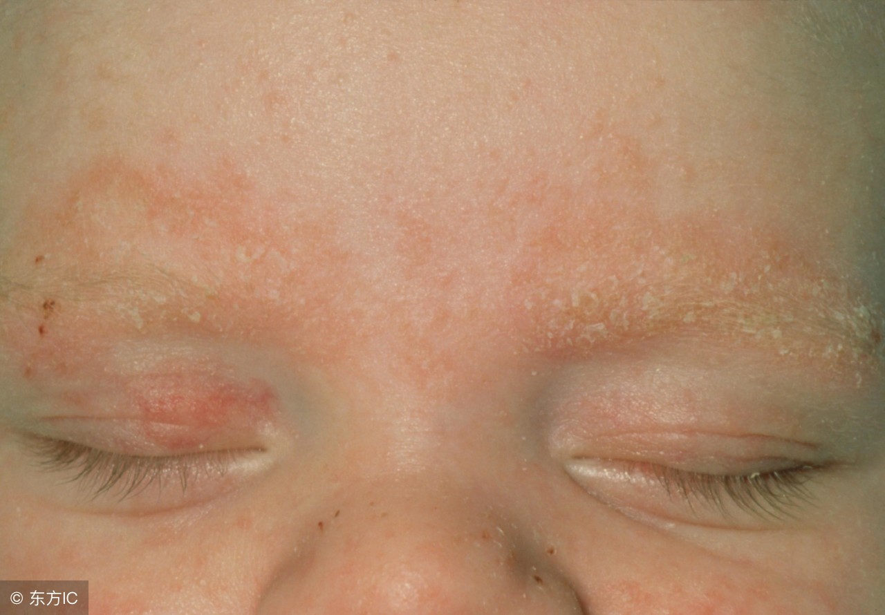 宝宝米粉里面加蛋黄会湿疹吗,干性湿疹快好了能给孩子吃蛋黄么