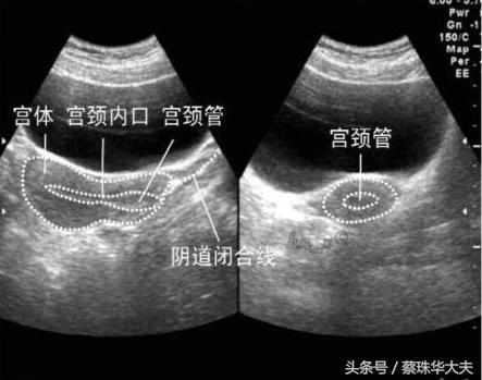 怀孕做阴道B超，会引起流产吗？