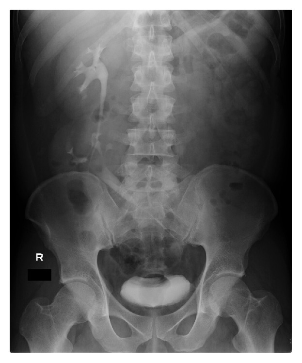 一侧肾异位孩子能要吗,异位肾融合是什么意思