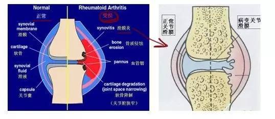 膝盖又肿了,膝盖滑膜炎好不了吗