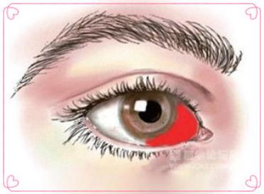 红眼痛怎么回事,不疼不痒眼睛肿是怎么回事