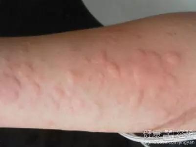 八岁孩子荨麻疹反复发是什么原因,小儿过敏性荨麻疹专家