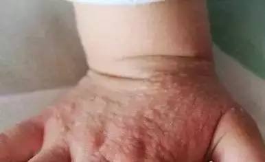 小朋友手上长红色大疙瘩,4岁男孩手上长满了小红疙瘩