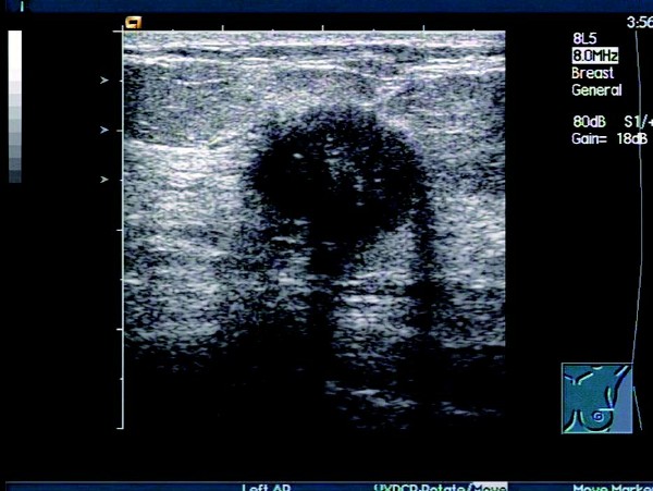 乳腺癌的超声图像表现,早期乳腺癌的超声表现