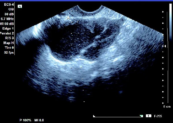 卵巢巧克力囊肿彩超描述,卵巢巧克力囊肿的超声诊断要点