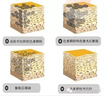 超q激光祛斑 (调q和点阵激光祛斑哪个效果好)