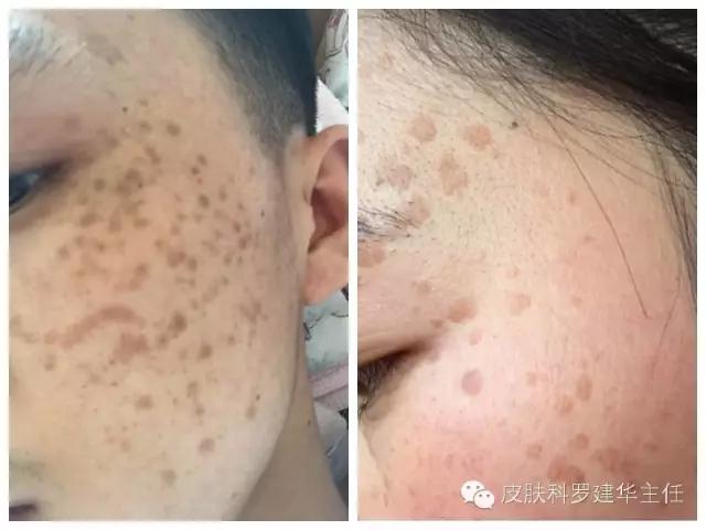 皮肤病扁平疣怎么治疗最好,液氮治疗扁平疣周围皮肤变黑