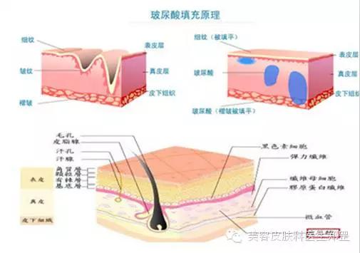 除皱针延缓衰老,除皱针让衰老来得慢些
