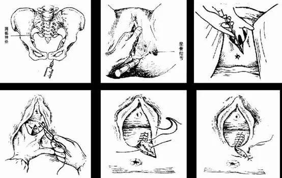 侧切部位如何护理,侧切部位怎么护理