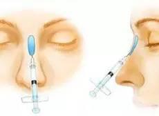 鼻整形有黄金阶段吗,怎么提高鼻子整形成功率