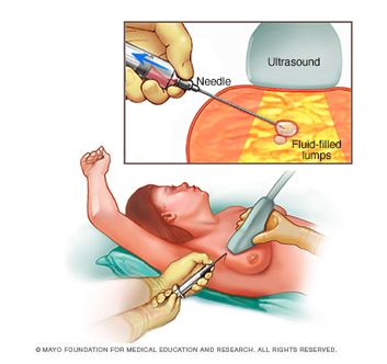 发现乳房肿块怎么办？美国权威评估和诊断，值得收藏！