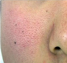 毛孔粗大肌肤怎么改善,毛孔粗大肌肤修复方案