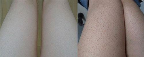 你是哪种类型的鸡皮肤,根治鸡皮肤最好的方法