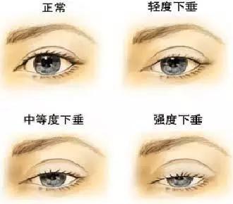 儿童眼病筛查中最常用的检查方法,检查幼儿眼睛近视的方法