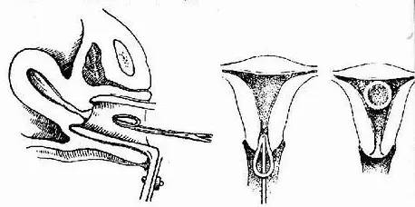 什么样的女性不适合上环,单身女性上环是什么心态