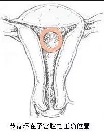 什么样的女性不适合上环,单身女性上环是什么心态
