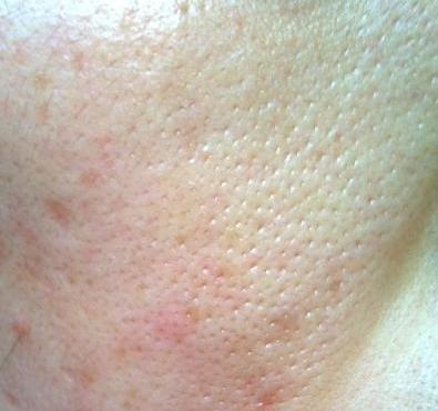 毛孔粗大怎么消除,毛孔粗大怎么消除最有效