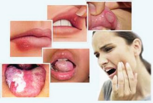 满嘴口腔溃疡怎么治,满嘴口腔溃疡怎么治疗