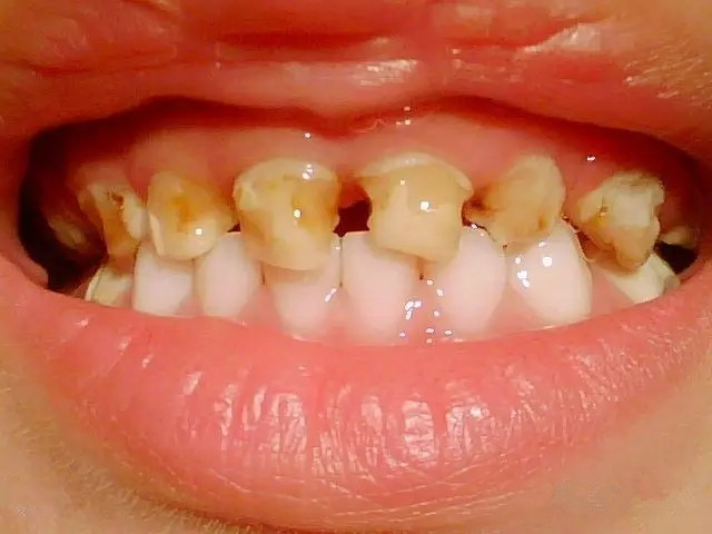 孩子牙釉质发育不全怎么补救,儿童牙釉质发育不全严重