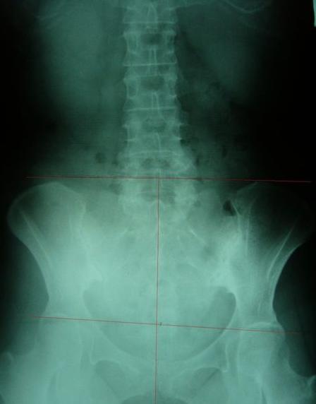 屁股歪了是怎么回事,屁股歪了骨盆怎么矫正