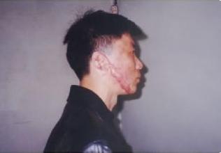 受伤了怕留疤该做些什么,如何处理刀疤不留疤痕