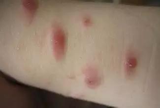 八岁孩子荨麻疹反复发是什么原因,小儿过敏性荨麻疹专家